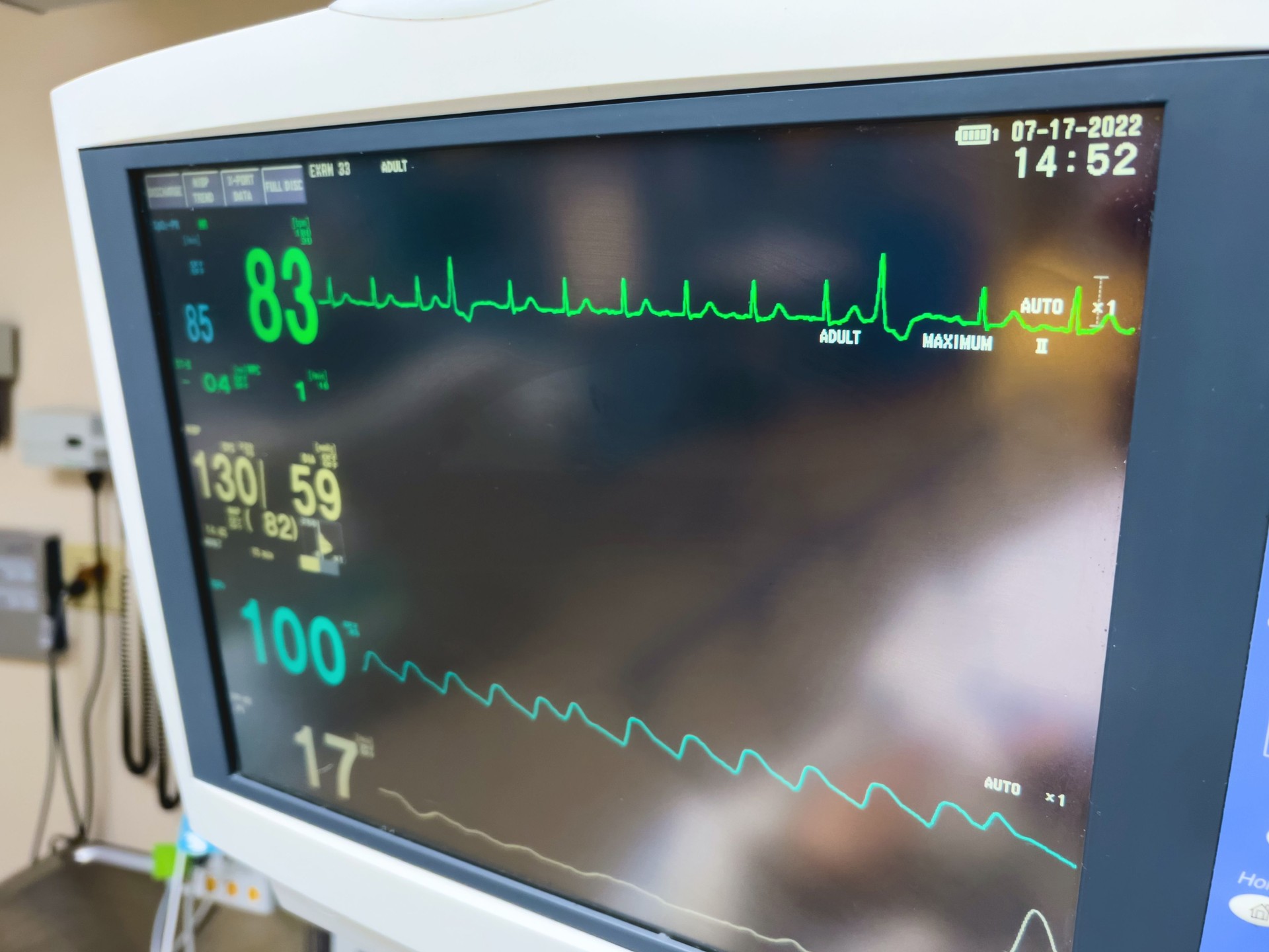 Heart Rate 83 Hospital Equipment Monitoring Vital Functions (vital signs) Monitor in an Operating Room Photo Series